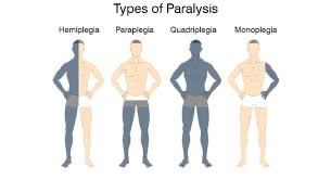 paralýza